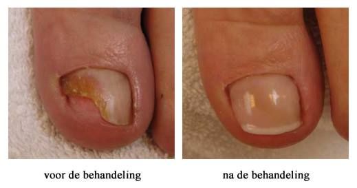 schimmelnagel behandeling
