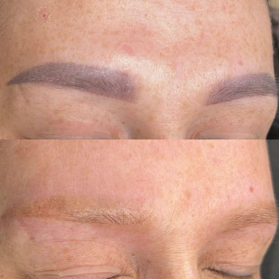 Pmu wenkbrauw verwijdering