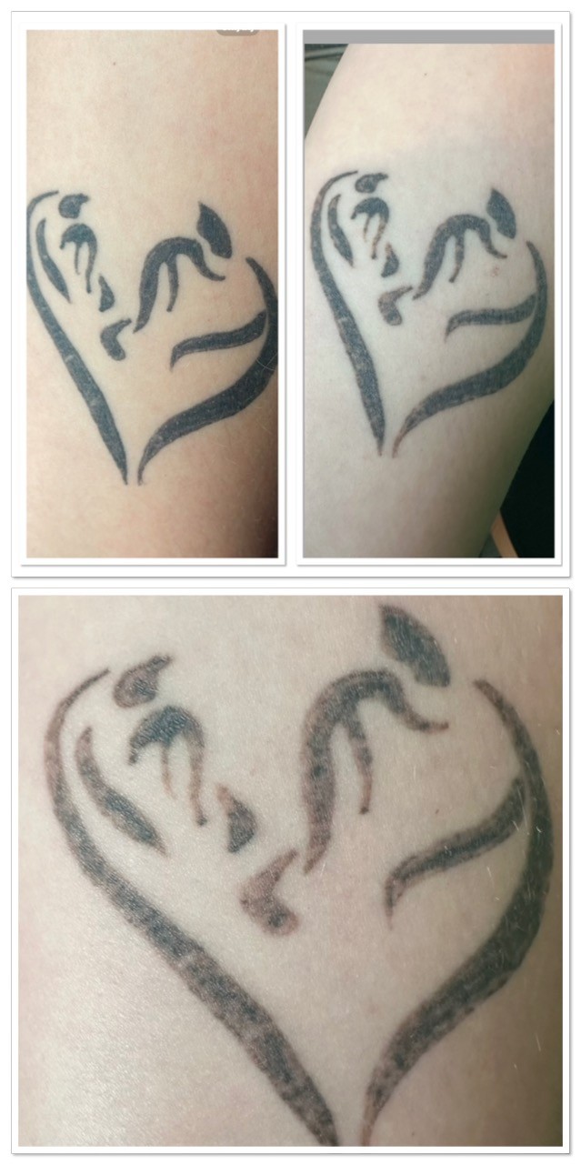 Tatoeage verwijderen