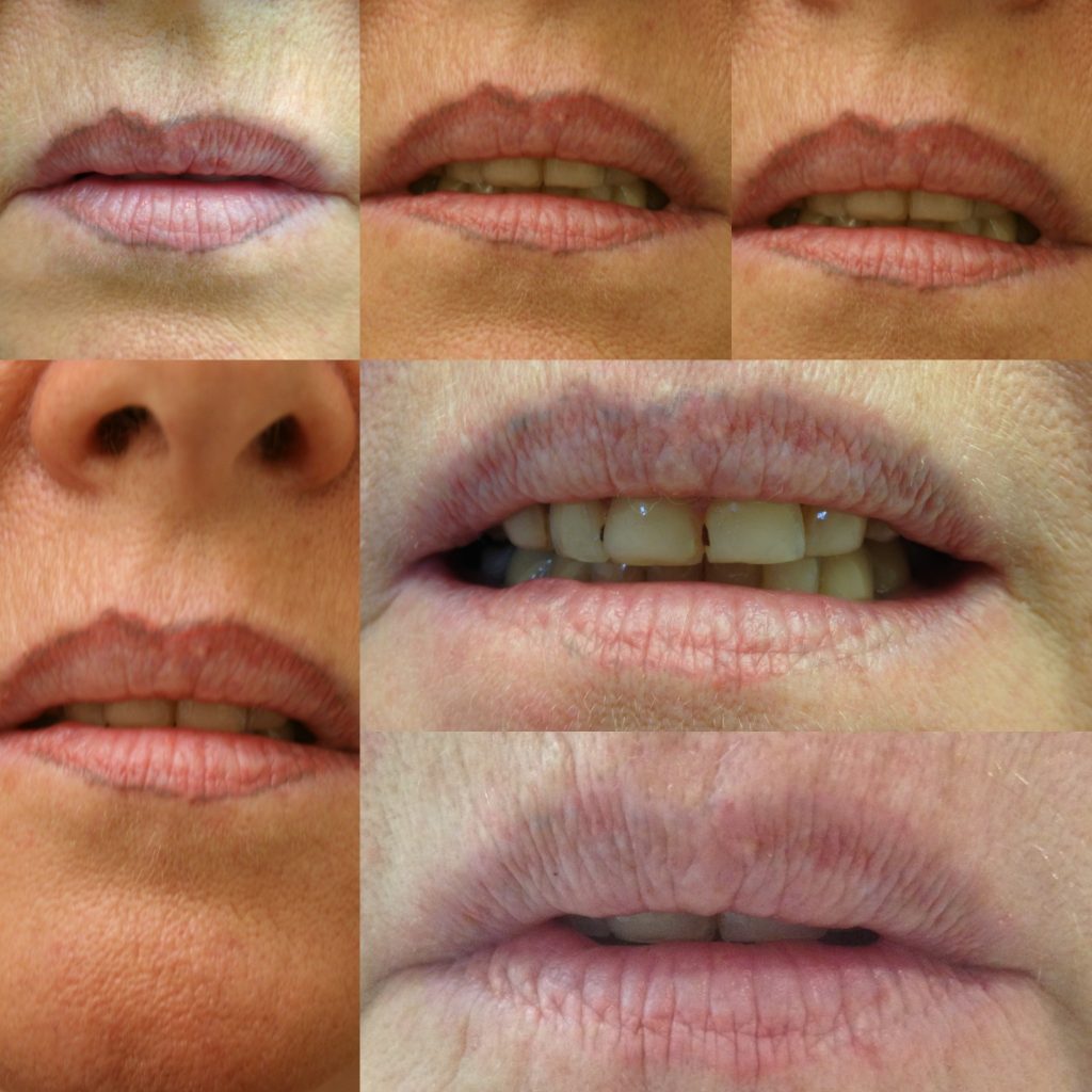 pmu lip-liner verwijdering