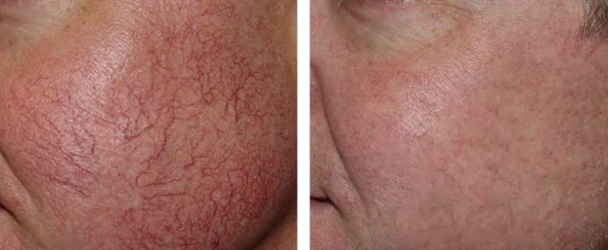 Couperose/haarvaten behandeling