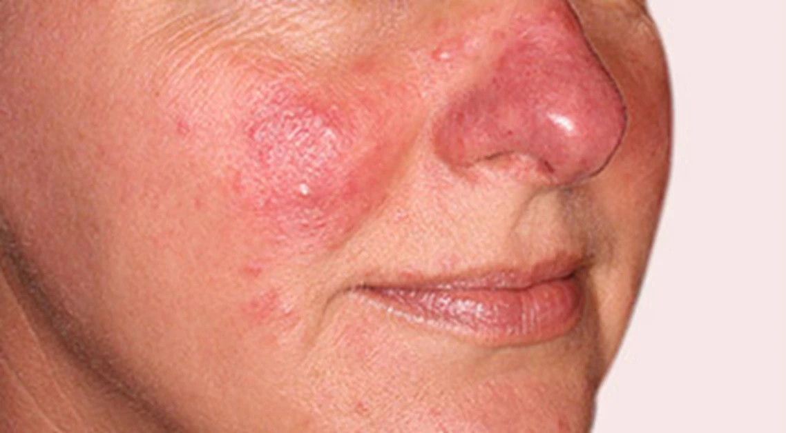 Rosacea